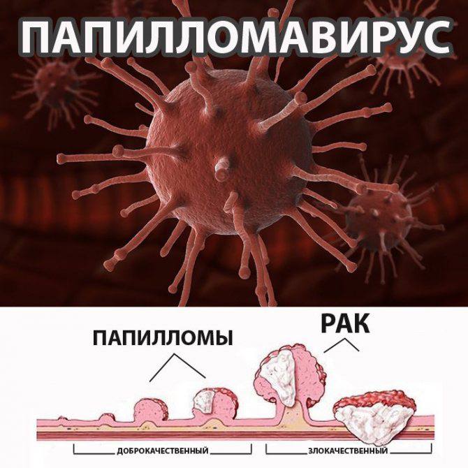 Папиллома человека у женщин фото лечение