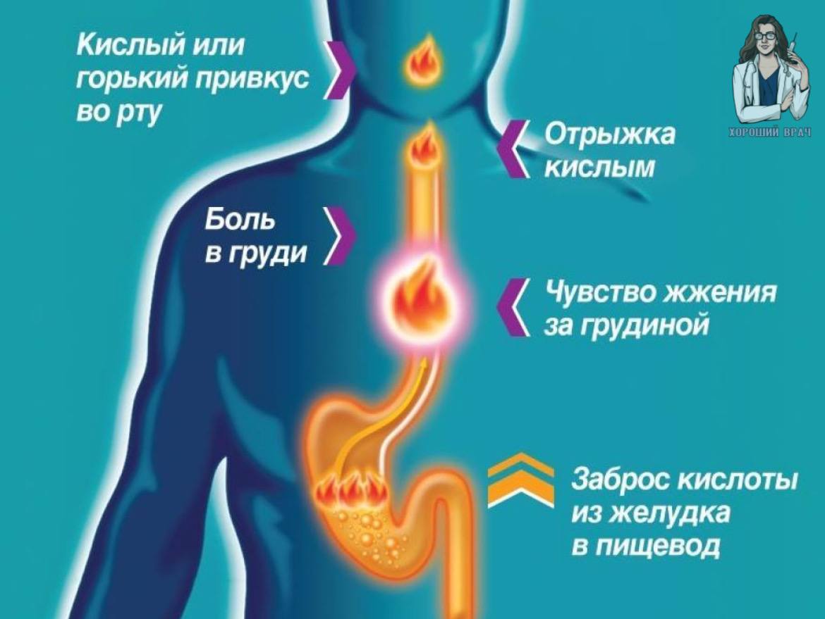 Голодная кислота. Симптомы изжоги желудка. Основные причины изжоги.