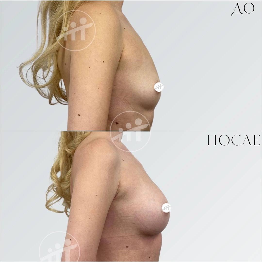 как увеличивается грудь во время беременности фото фото 17