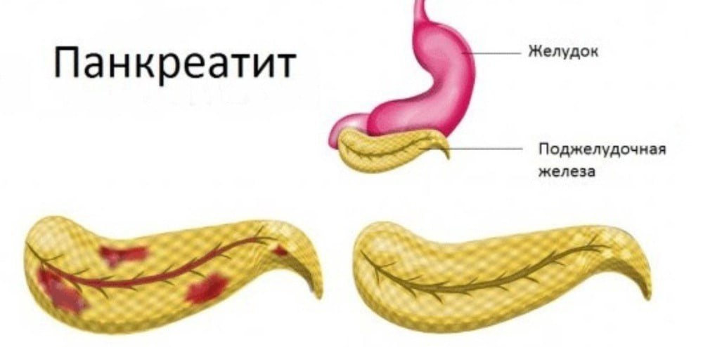 Панкреатический стул